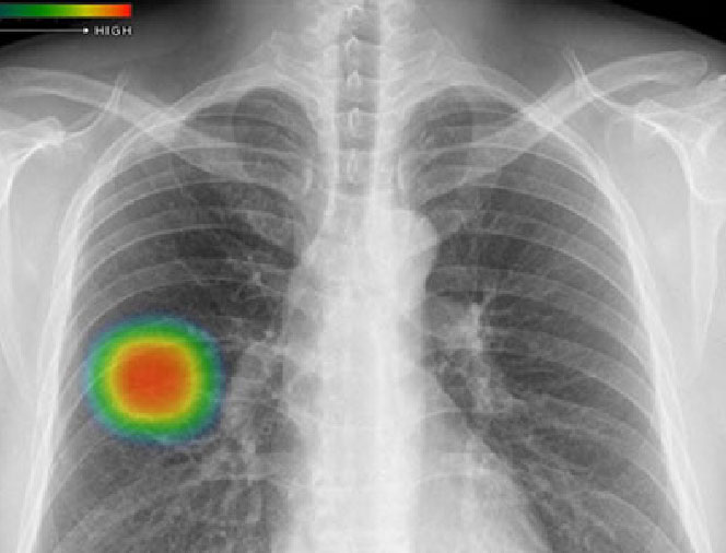 胸部X線画像病変検出ソフトウェア